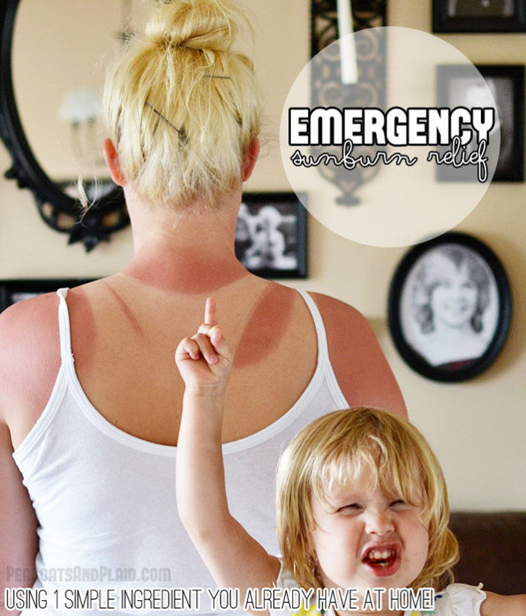 Emergency ONE Ingredient Home Sunburn Remedy With Photo Evidence